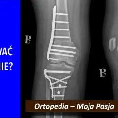 Rentgen kolana z implantami po złamaniu. Pytanie: Czy usuwać zespolenie? #ortopedia