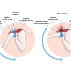 Anatomia stawu mostkowo obojczykowego: prawidłowe położenie ścięgna mięśnia nadgrzebieniowego i kaletki podbarkowej oraz ucisk na te struktury.