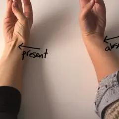 Porównanie obecności mięśnia dłoniowego długiego na dwóch przedramionach. Na jednym widoczny, na drugim nie.