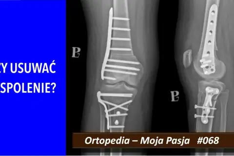 Rentgen kolana z implantami po złamaniu. Pytanie: Czy usuwać zespolenie? #ortopedia