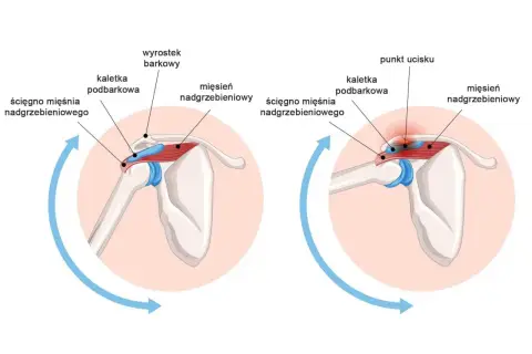 Anatomia stawu mostkowo obojczykowego: prawidłowe położenie ścięgna mięśnia nadgrzebieniowego i kaletki podbarkowej oraz ucisk na te struktury.