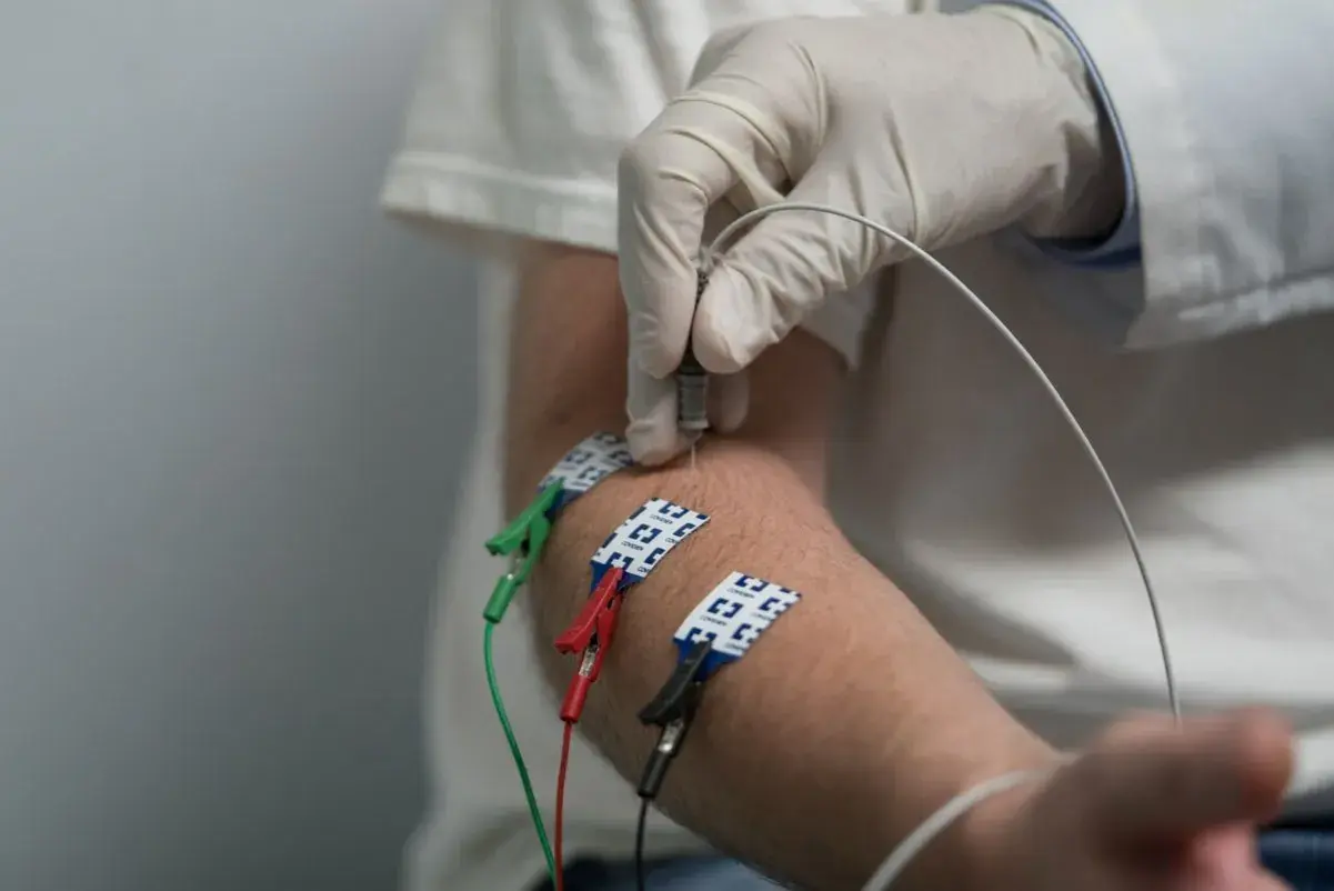 Lekarz w białej rękawiczce wykonuje badanie nerwów obwodowych, wprowadzając igłę do ramienia pacjenta. Elektrody są przymocowane do skóry.
