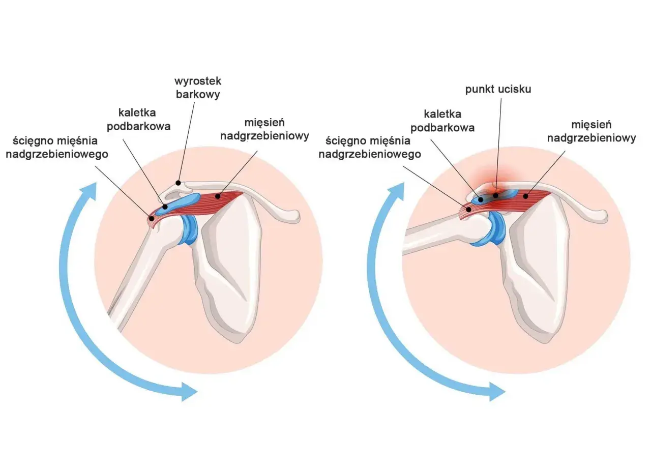 Anatomia stawu mostkowo obojczykowego: prawidłowe położenie ścięgna mięśnia nadgrzebieniowego i kaletki podbarkowej oraz ucisk na te struktury.