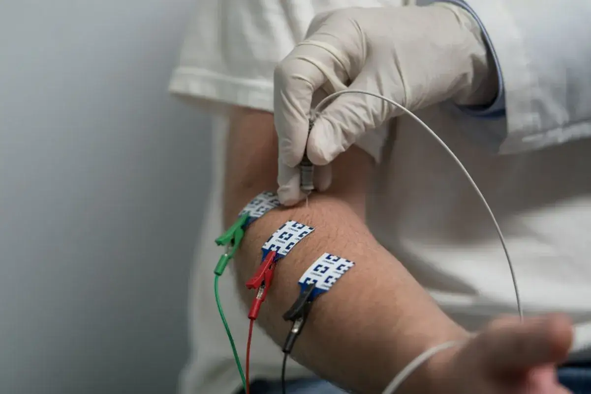 Lekarz w białej rękawiczce wykonuje badanie nerwów obwodowych, wprowadzając igłę do ramienia pacjenta. Elektrody są przyczepione do skóry.