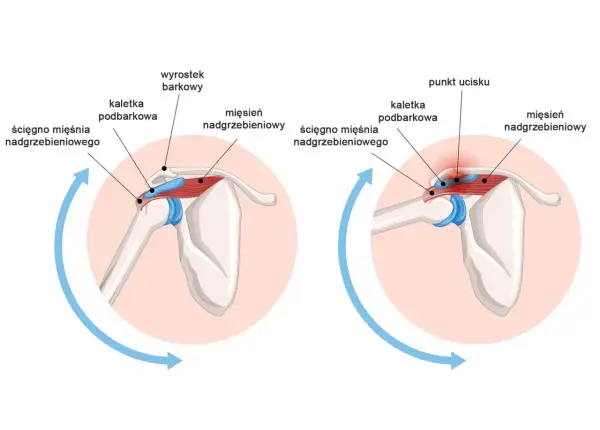Anatomia stawu mostkowo obojczykowego: prawidłowe położenie ścięgna mięśnia nadgrzebieniowego i kaletki podbarkowej oraz ucisk na te struktury.
