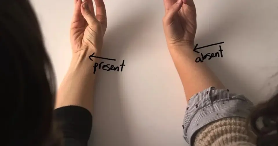 Mięsień dłoniowy długi - anatomia, funkcja i znaczenie kliniczne